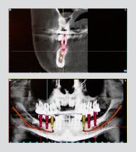 Virtuelle 3D-Implantatplanung mittels SimPlant